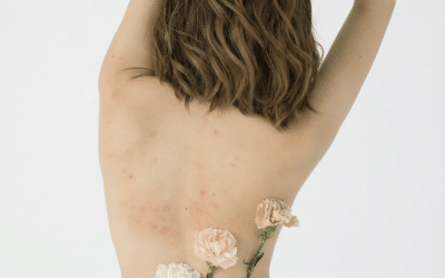 Back Acne Scarring: Causes and Treatment Options